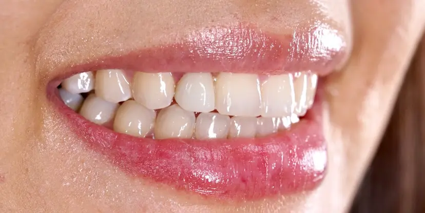 After dental implant treatment showing restored natural-looking teeth at Gupta Dental Chandigarh