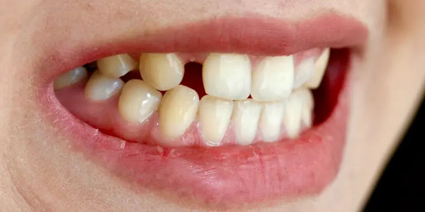 Before dental implant treatment showing missing teeth at Gupta Dental Chandigarh