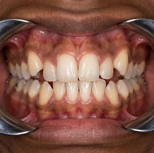 Before invisible aligner treatment showing crooked teeth at Gupta Dental Tricity