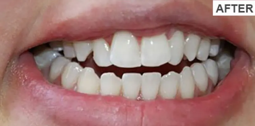 After teeth whitening treatment showing brighter white teeth at Gupta Dental Panchkula