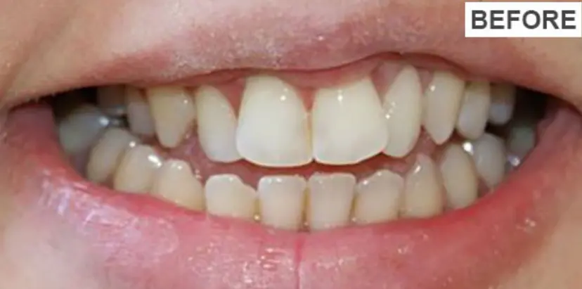Before teeth whitening treatment showing yellow and stained teeth at Gupta Dental Panchkula