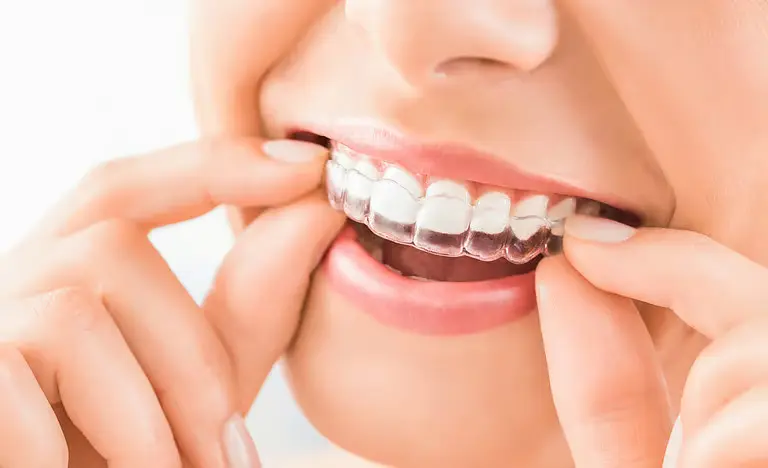 Orthodontic braces and invisible aligners treatment at Gupta Dental Hospital Chandigarh