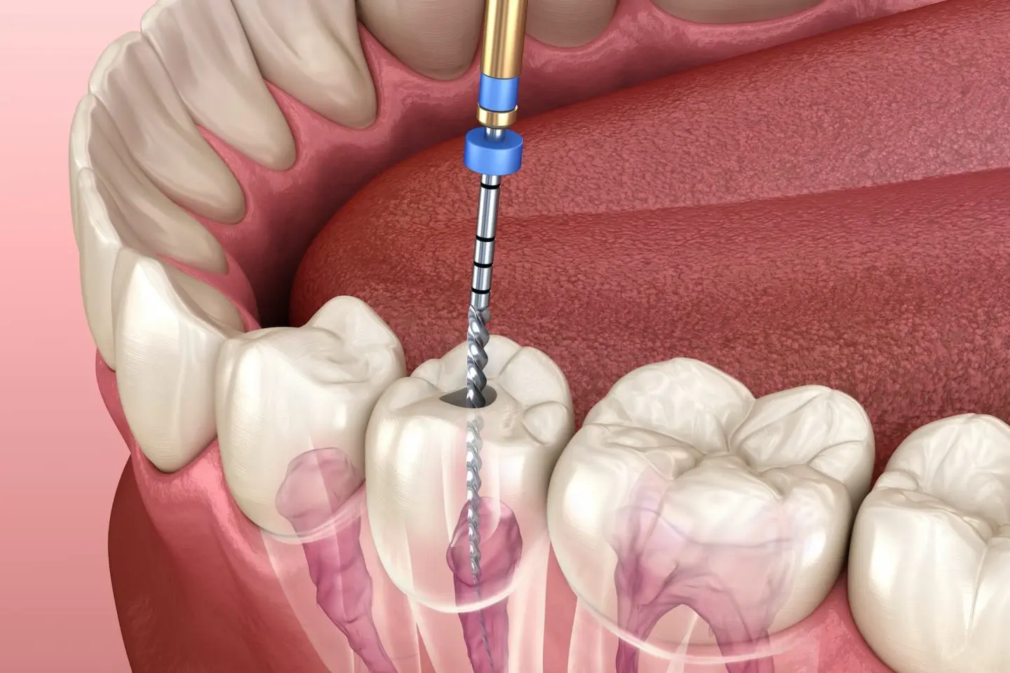 Painless root canal treatment using advanced rotary endodontics at Gupta Dental Chandigarh