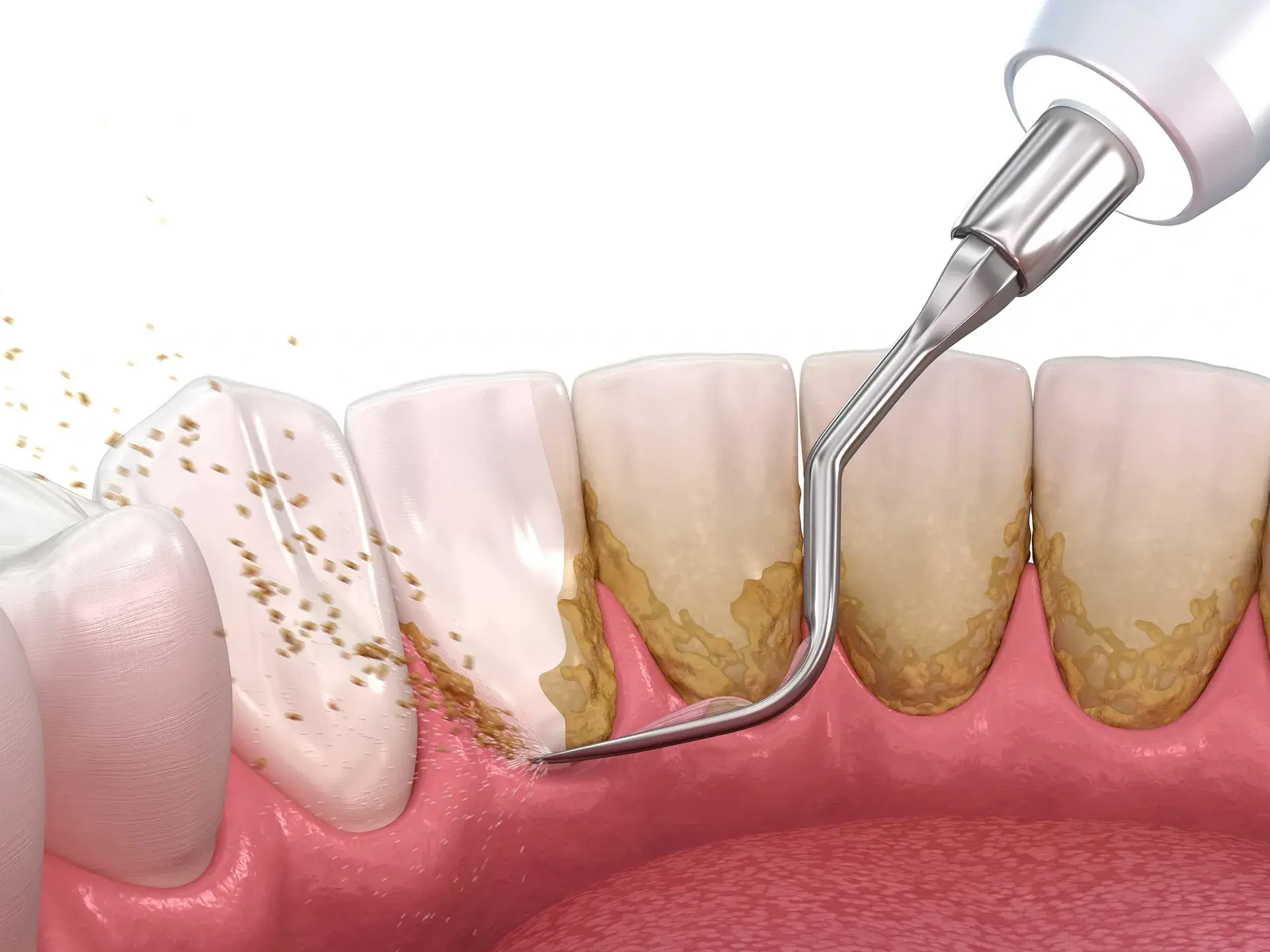 Professional teeth cleaning and scaling procedure at dental clinic in Chandigarh